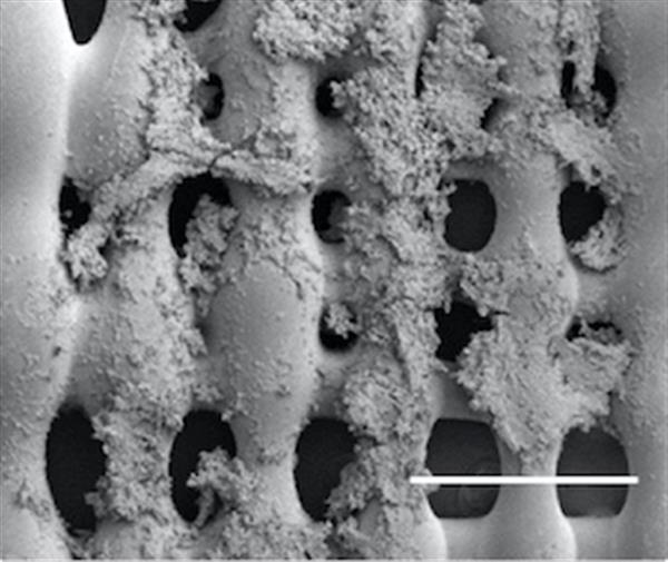 Understanding Bone Cancer Tumors with 3D Printed Scaffolds and Flow Perfusion