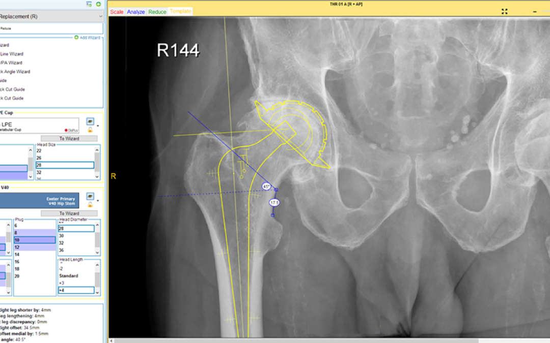 UK Surgeon Uses Materialise OrthoView Software for Pre-Planning Surgical Success in 39 Hip Procedures