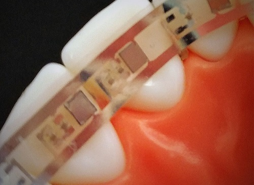 3D Printed Smart Braces with Flexible Batteries and LEDs Can Improve Efficiency of Orthodontic Alignment