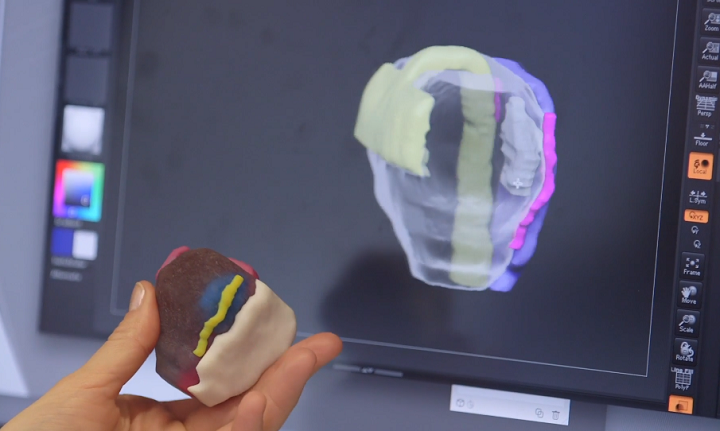 PhD Candidate 3D Printing Kidney and Prostate Models for Clinical Trial with Stratasys