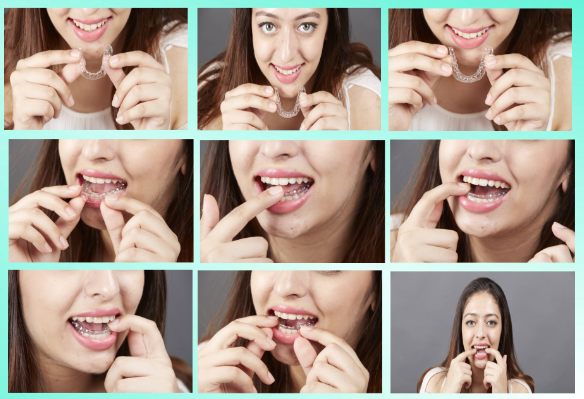 Alignwise Uses 3D Printing to Manufacture Nearly Invisible, Painless Orthodontic Aligners