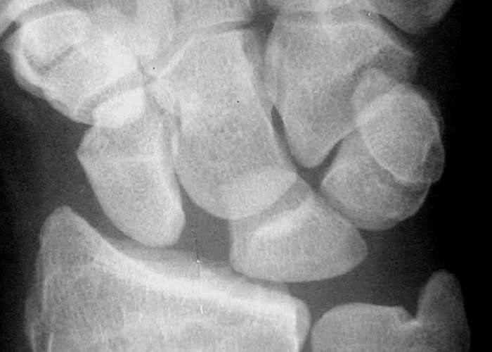 Australian Researchers Using Bioengineering and 3D Printing to Design Better Replacement Bone Ligament Constructs